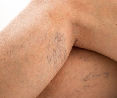 Żylaki – problem estetyczny czy poważne zagrożenie dla zdrowia?